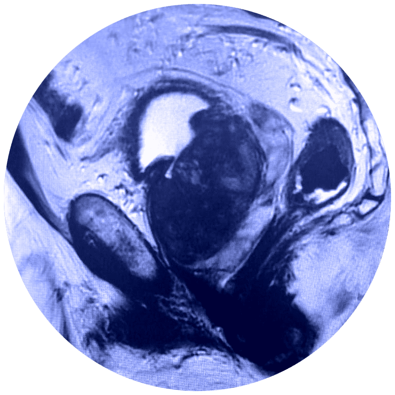 Multiparamétrico de próstata con resonancia magnética